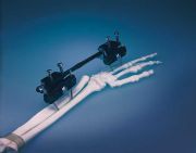 复合材料颅环固定器